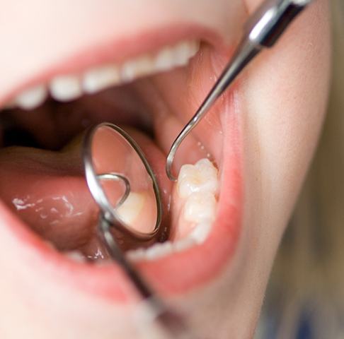 Closeup of a kid getting a children’s tooth-colored filling in Jeffersonville