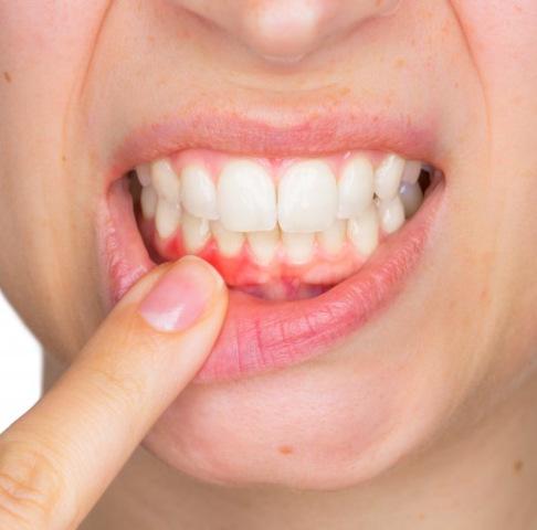 Closeup of patient pointing to their red, inflamed gums